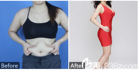 廣州曙光王娟雙眼皮<span style= 廣州美萊張毓醫(yī)生吸脂和脂肪隆胸<span style=