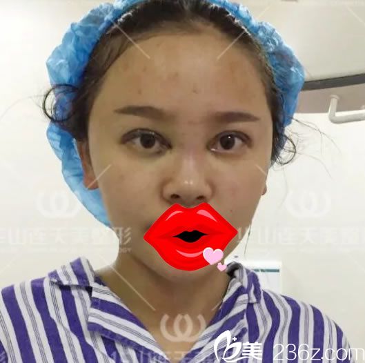 10mm雙眼皮手術(shù)即刻效果圖 10mm雙眼皮手術(shù)即刻效果圖