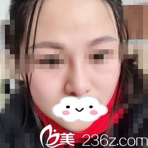 找黃世揮院長做鼻綜合，一下子解決了我的鼻頭肥大和鼻翼寬問題