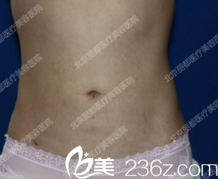 吸脂后一個月照片 吸脂后一個月照片