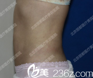 術后四十五天的樣子 術后四十五天的樣子