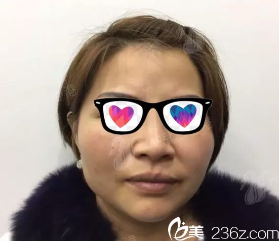 做自體脂肪填充前顯老的照片 做自體脂肪填充前顯老的照片