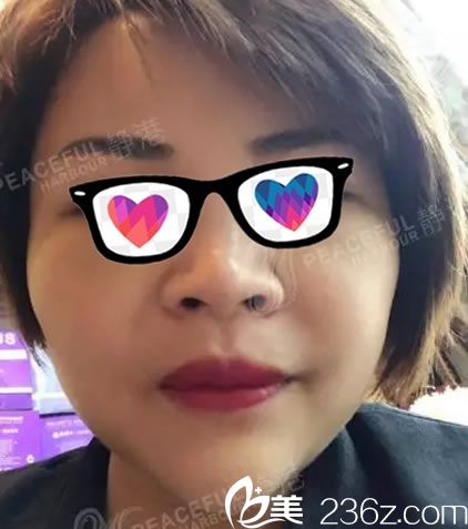 做自體脂肪填充全臉術(shù)后2天照片 做自體脂肪填充全臉術(shù)后2天照片