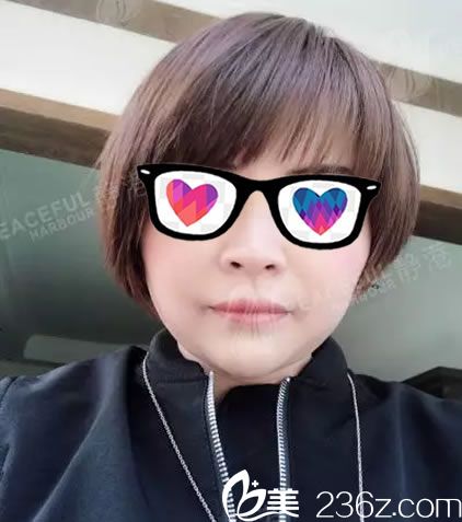 寧波靜港脂肪填充全臉案例5天效果 寧波靜港脂肪填充全臉案例5天效果