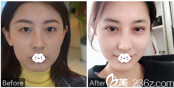 廣州紫馨趙晟弼做的雙眼皮案例 廣州紫馨趙晟弼做的雙眼皮案例