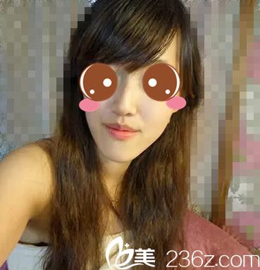 韓國AJ整形外科李秉烈顴骨整形和下巴縮小真人案例 韓國AJ整形外科李秉烈顴骨整形和下巴縮小真人案例