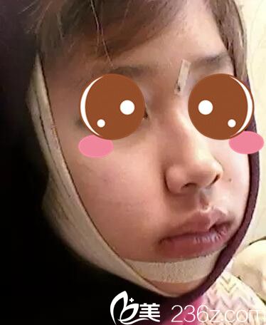 真人案例術(shù)后第二天 真人案例術(shù)后第二天