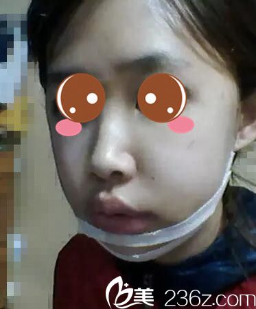 真人案例術(shù)后第七天 真人案例術(shù)后第七天