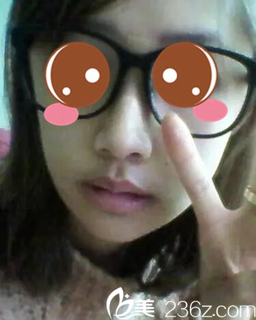 真人案例術(shù)后二十天 真人案例術(shù)后二十天