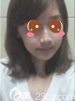 真人案例術(shù)后一個月 真人案例術(shù)后一個月