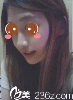 韓國(guó)AJ李秉烈為我做的顴骨整形+下巴縮小，一掃之前的老氣橫秋