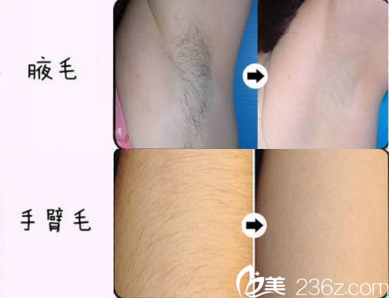 激光脫腋毛和手臂脫毛真人案例