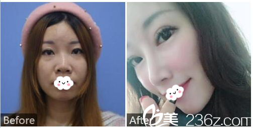 廣州紫馨金孝憲做的鼻綜合隆鼻案例 廣州紫馨金孝憲做的鼻綜合隆鼻案例