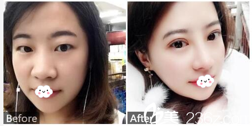 廣州紫馨金孝憲做的雙眼皮和隆鼻案例