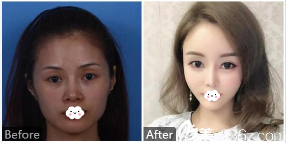 廣州紫馨金孝憲做鼻子案例圖片 廣州紫馨金孝憲做鼻子案例圖片