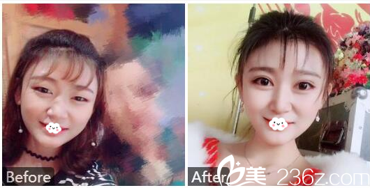 廣州美萊陳貴宗做的切開雙眼皮<span style=