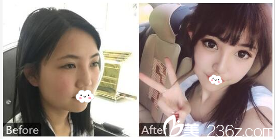 廣州美萊羅延平做的假體隆鼻<span style=