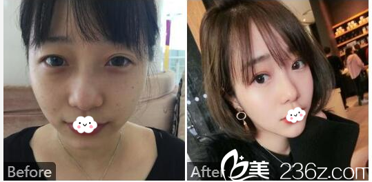 廣州美萊陳貴宗雙眼皮案例效果圖 廣州美萊陳貴宗雙眼皮案例效果圖