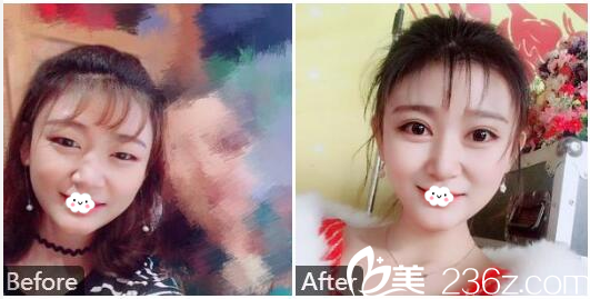 廣州美萊陳貴宗做的雙眼皮案例 廣州美萊陳貴宗做的雙眼皮案例