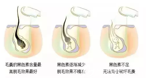 冰點(diǎn)脫毛原理示意圖 冰點(diǎn)脫毛原理示意圖