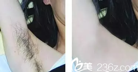 綿陽朗睿整形脫腋毛案例 綿陽朗睿整形脫腋毛案例