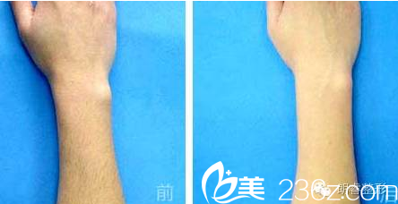 綿陽朗睿上臂脫毛案例 綿陽朗睿上臂脫毛案例