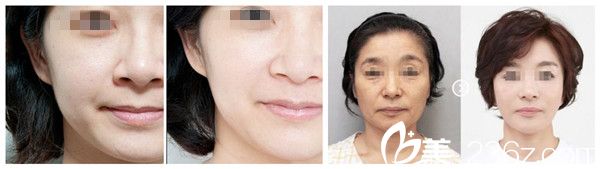 吳春艷院長除皺案例 吳春艷院長除皺案例