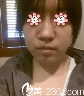 術(shù)前的我 術(shù)前的我