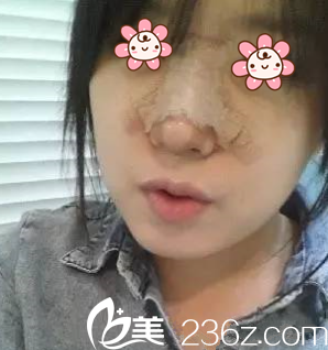 胡凱醫(yī)生給我做完術(shù)后第三天 胡凱醫(yī)生給我做完術(shù)后第三天