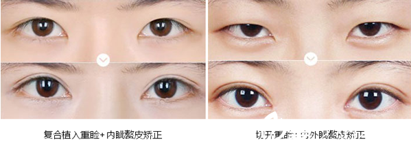 內(nèi)江達(dá)芬奇整形雙眼皮術(shù)后效果對(duì)比照