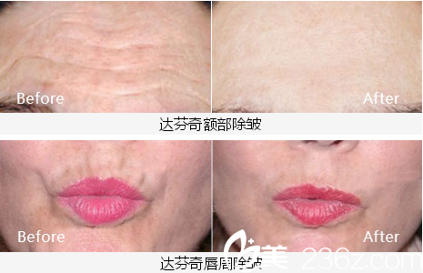 內(nèi)江達(dá)芬奇整形醫(yī)院除皺案例 內(nèi)江達(dá)芬奇整形醫(yī)院除皺案例