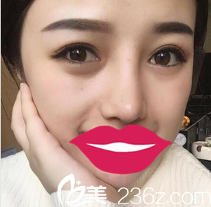 膨體隆鼻+鼻頭縮小術(shù)后2個(gè)月照片