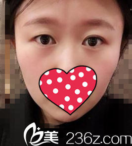 做雙眼皮術(shù)前照 做雙眼皮術(shù)前照