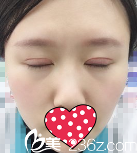 納米無痕雙眼皮半個(gè)月效果 納米無痕雙眼皮半個(gè)月效果