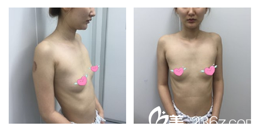 沒有去合肥韓美整形外科醫(yī)院做硅膠假體隆胸前的胸型 沒有去合肥韓美整形外科醫(yī)院做硅膠假體隆胸前的胸型