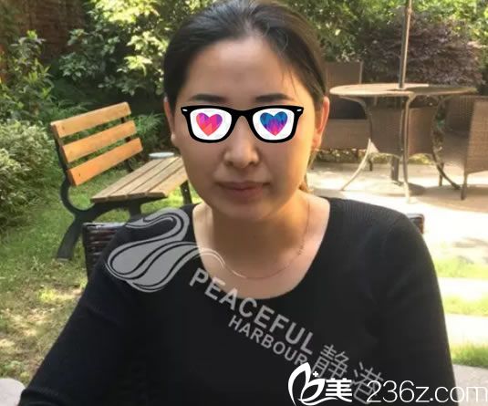 40歲的玉玲做埋線提升前照片 40歲的玉玲做埋線提升前照片