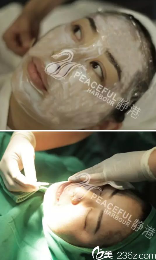 寧波靜港面部線雕手術(shù)過(guò)程圖 寧波靜港面部線雕手術(shù)過(guò)程圖