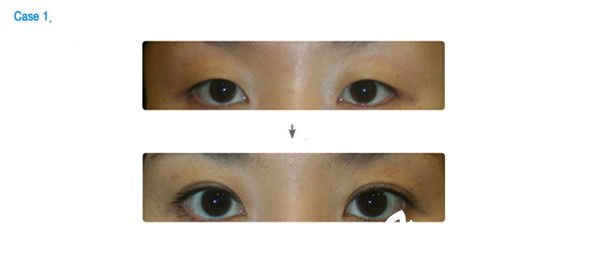 韓國(guó)可恩愛(ài)整形外科醫(yī)院院長(zhǎng)李圣吉雙眼皮手術(shù)真人案例