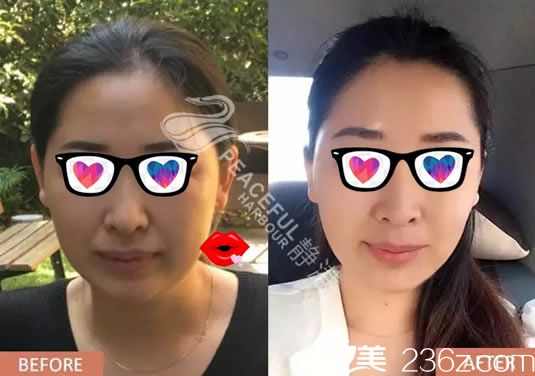 寧波靜港程衛(wèi)民面部線雕案例對(duì)比圖 寧波靜港程衛(wèi)民面部線雕案例對(duì)比圖