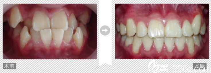 矯正牙齒怎么樣 矯正牙齒怎么樣