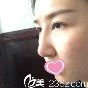 九江瑞麗醫(yī)療美容醫(yī)院完成雙眼皮真人案例 九江瑞麗醫(yī)療美容醫(yī)院完成雙眼皮真人案例