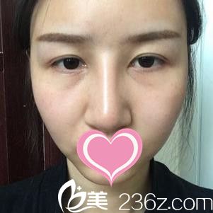 萬成隆鼻手術(shù)案例 萬成隆鼻手術(shù)案例