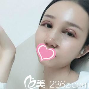 九江瑞麗雙眼皮+隆鼻手術(shù)真人案例 九江瑞麗雙眼皮+隆鼻手術(shù)真人案例