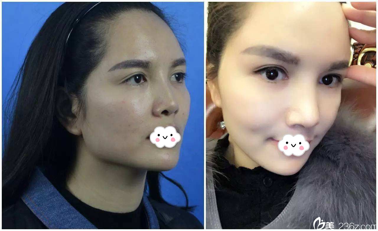 東營市雅豐醫(yī)療美容整形醫(yī)院整形醫(yī)生李揆潤隆鼻案例 東營市雅豐醫(yī)療美容整形醫(yī)院整形醫(yī)生李揆潤隆鼻案例