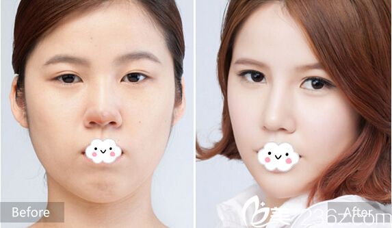 東營市雅豐整形醫(yī)院李揆潤隆鼻失敗修復(fù)案例 東營市雅豐整形醫(yī)院李揆潤隆鼻失敗修復(fù)案例