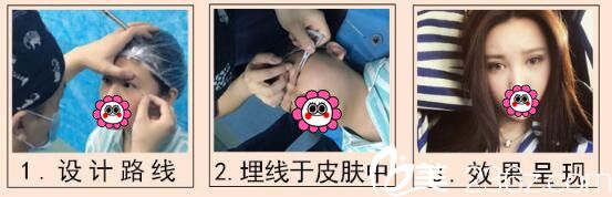 在無(wú)錫同舟做雙眼皮案例 在無(wú)錫同舟做雙眼皮案例