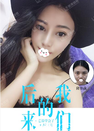 深圳麗港麗格整形醫(yī)院謝俊鼻綜合隆鼻案例