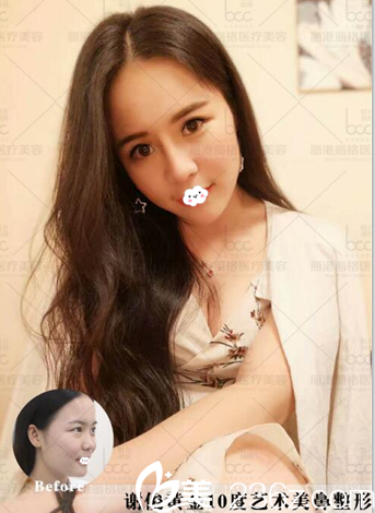 深圳麗港麗格整形醫(yī)院謝俊耳軟骨隆鼻案例圖