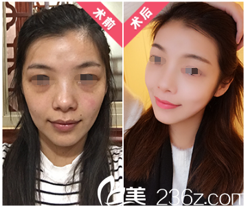 彭建醫(yī)生線雕提升案例