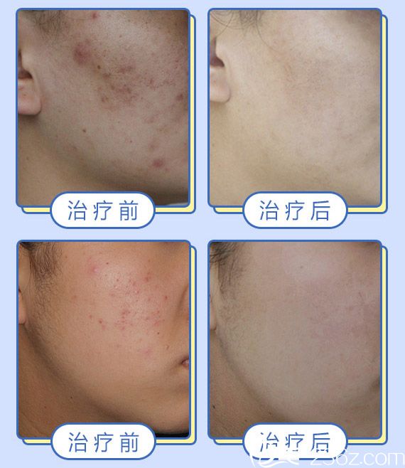 <!--<i data=20240703-sp></i>-->華醫(yī)生祛痘案例